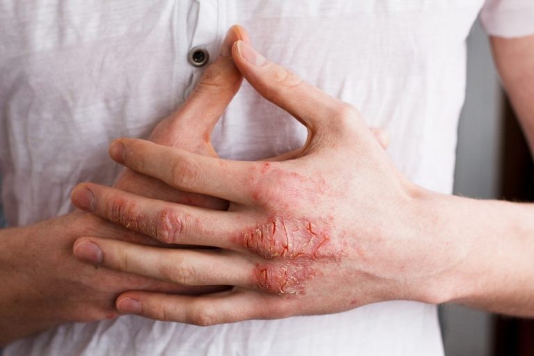 Eczema O Que é Sintomas E Tratamentos Cura Natural