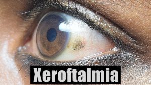 Xeroftalmia - o que é, causas, sintomas e tratamentos! | Cura Natural